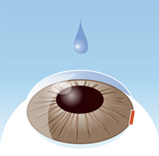 采用滴眼药水式麻醉，在角膜边缘做一个微小切口